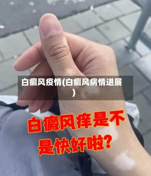 白癜风疫情(白癜风病情进展)