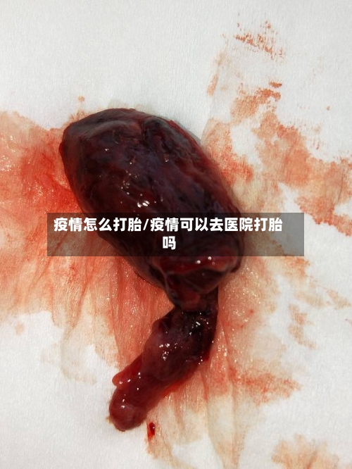疫情怎么打胎/疫情可以去医院打胎吗