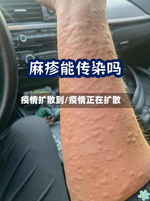 疫情扩散到/疫情正在扩散