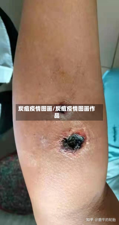 炭疽疫情图画/炭疽疫情图画作品