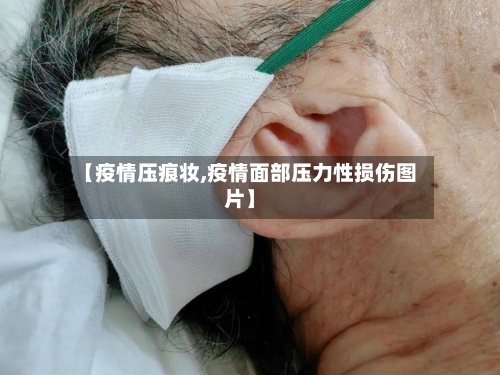 【疫情压痕妆,疫情面部压力性损伤图片】