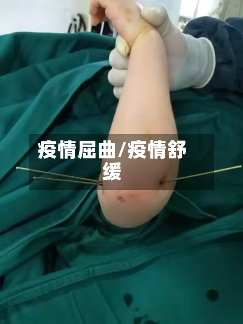 疫情屈曲/疫情舒缓