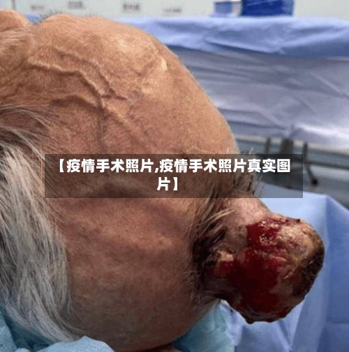 【疫情手术照片,疫情手术照片真实图片】