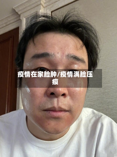 疫情在家脸肿/疫情满脸压痕