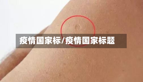 疫情国家标/疫情国家标题