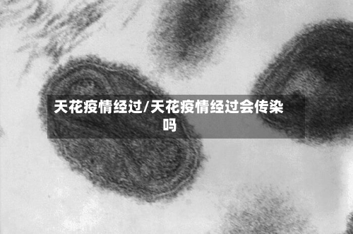 天花疫情经过/天花疫情经过会传染吗