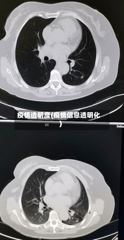疫情透明度(疫情信息透明化)