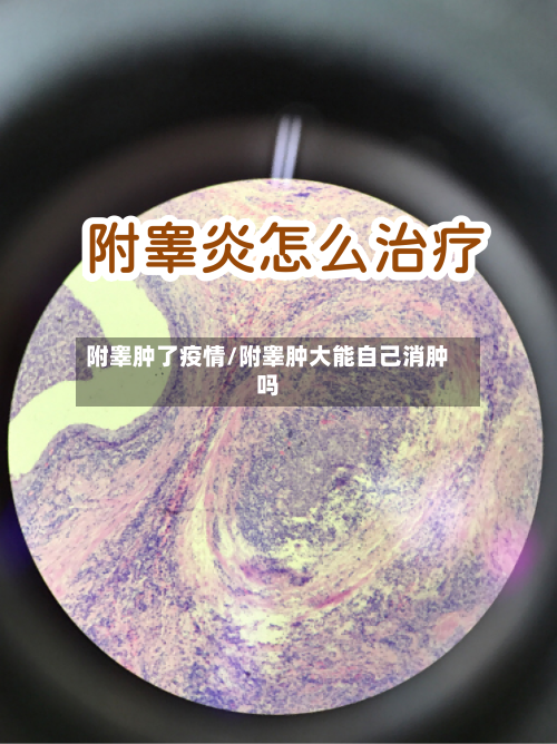 附睾肿了疫情/附睾肿大能自己消肿吗