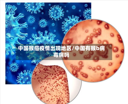 中国猴痘疫情出现地区/中国有猴b病毒病吗